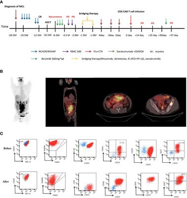 Immunophenotypic transformation in relapsed/refractory mantle cell lymphoma treated with human anti-CD5 chimeric antigen receptor T cells: A Case Report